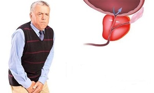 meeste prostatiidi sümptomid