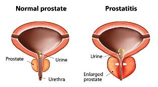 äge prostatiit ravi