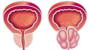 prostatiidi ja eesnäärme adenoomi arengu põhjused